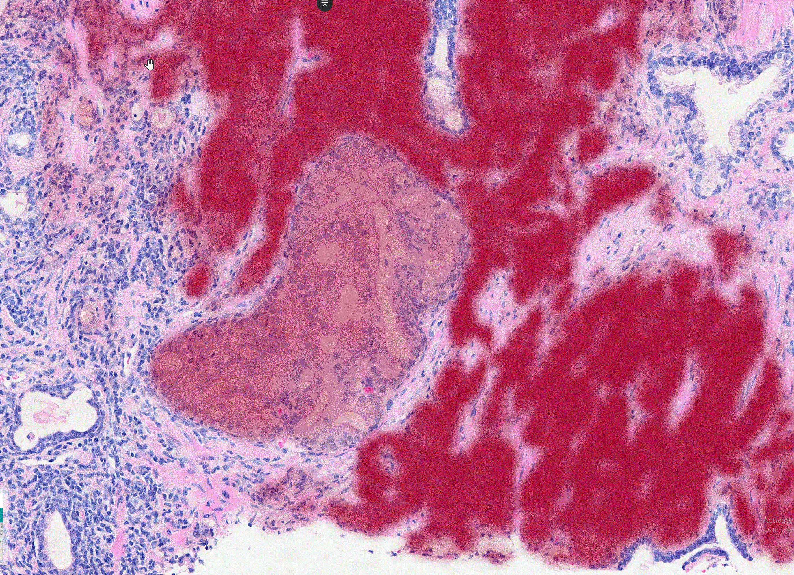 Simon Bott is the first in the UK to use AI assistance for Prostate Biopsy Results